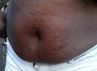 Infection de la peau : le MSPP appelle à la vigilance