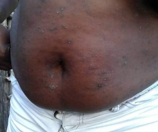 Infection de la peau : le MSPP appelle à la vigilance