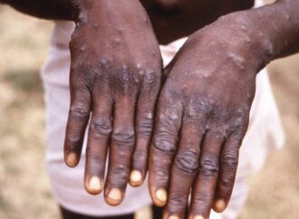 Santé : Un cas suspect de variole du singe découvert en Haïti
