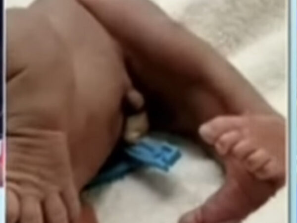 Haïti: Un enfant né avec ses deux jambes attachées ressemblant à une queue de poisson